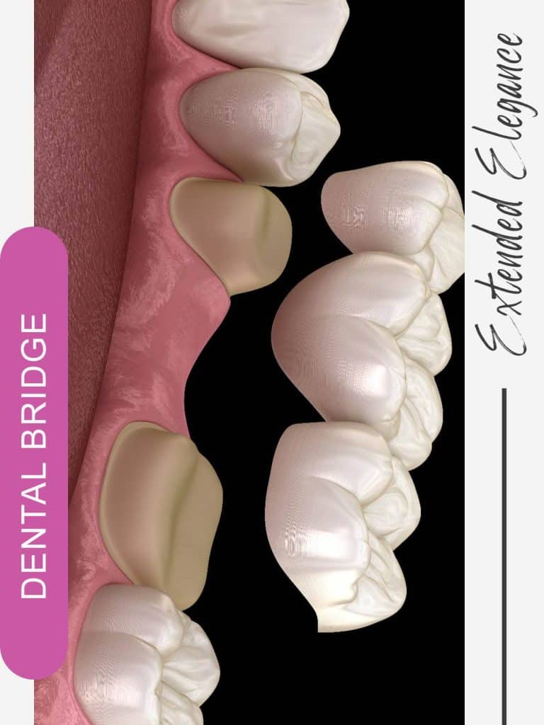dental bridge turkey