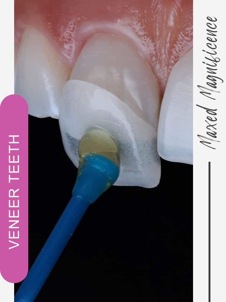veneer teeth turkey